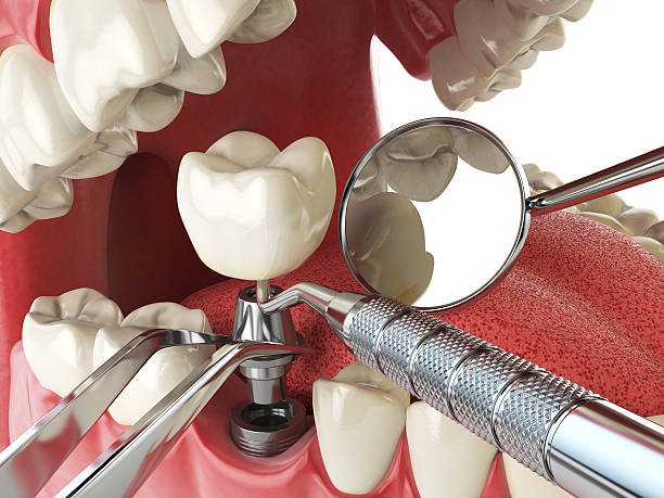 Best Emergency Denture Repair in Campbell, MO